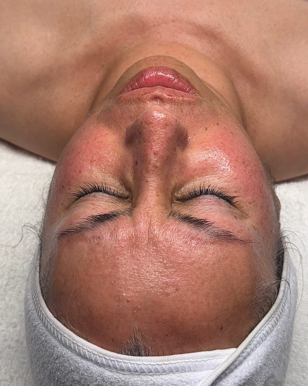 Before customized facial treatment at CYNNSBEAUTY