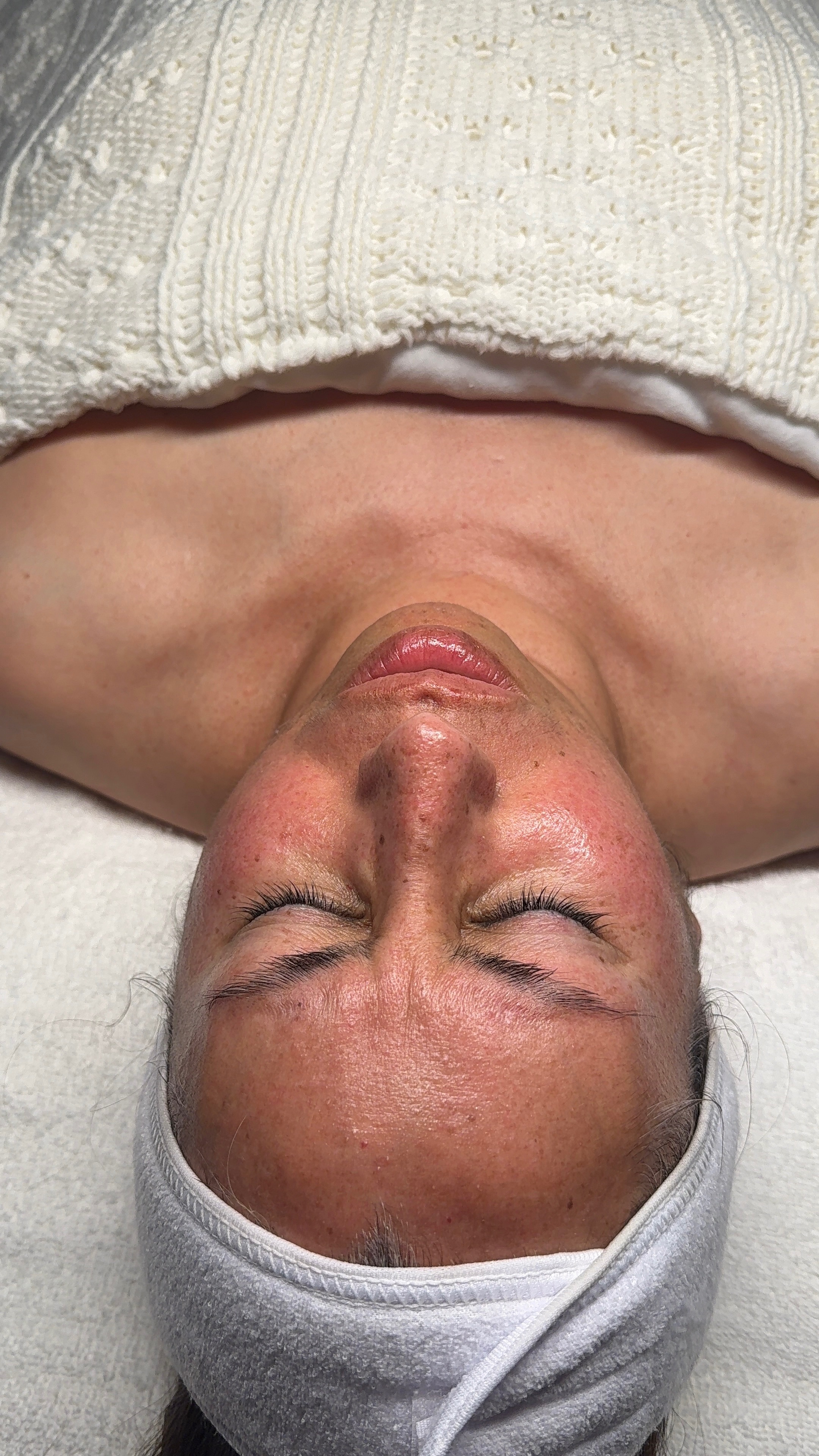 Before customized facial treatment at CYNNSBEAUTY