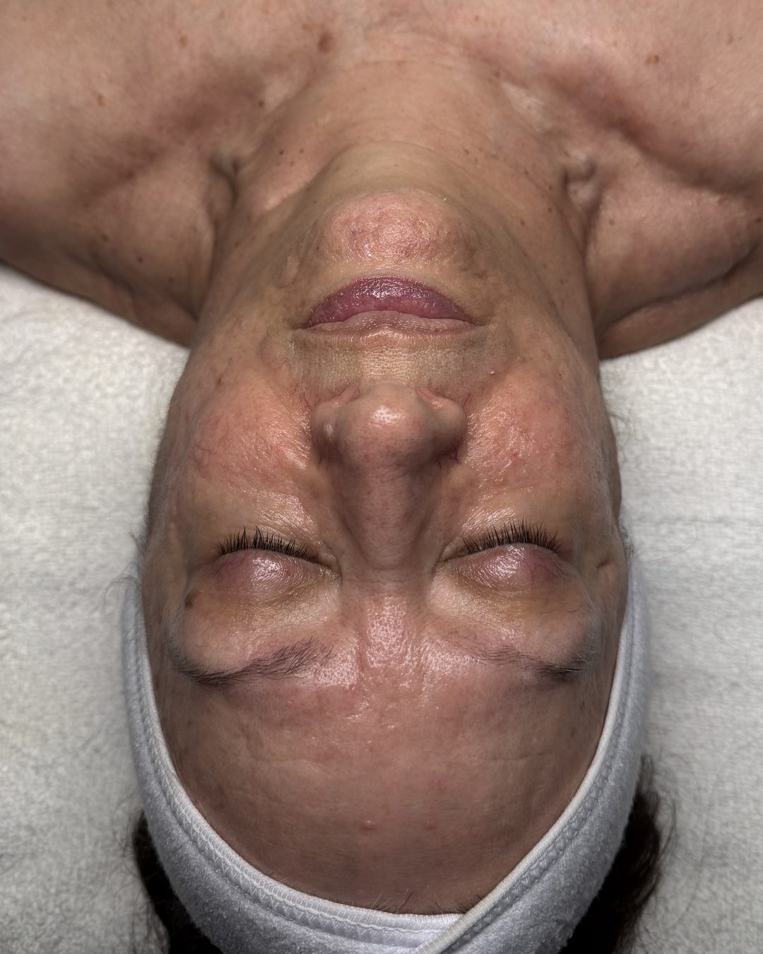 Before customized facial treatment at CYNNSBEAUTY