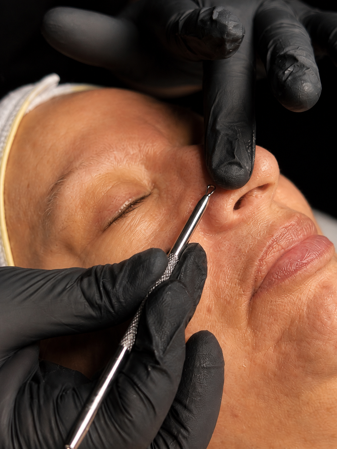 Close-up acne clarity facial extraction treatment at CYNNSBEAUTY