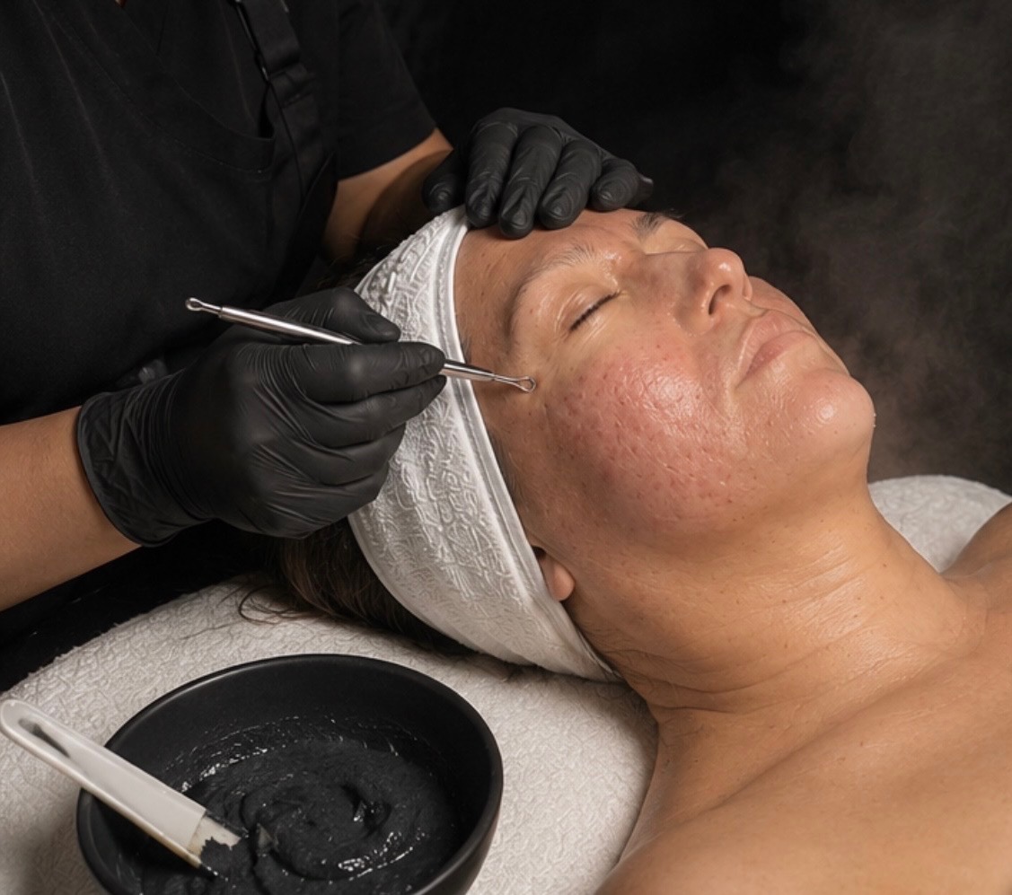Acne Recovery Facial extraction treatment at CYNNSBEAUTY